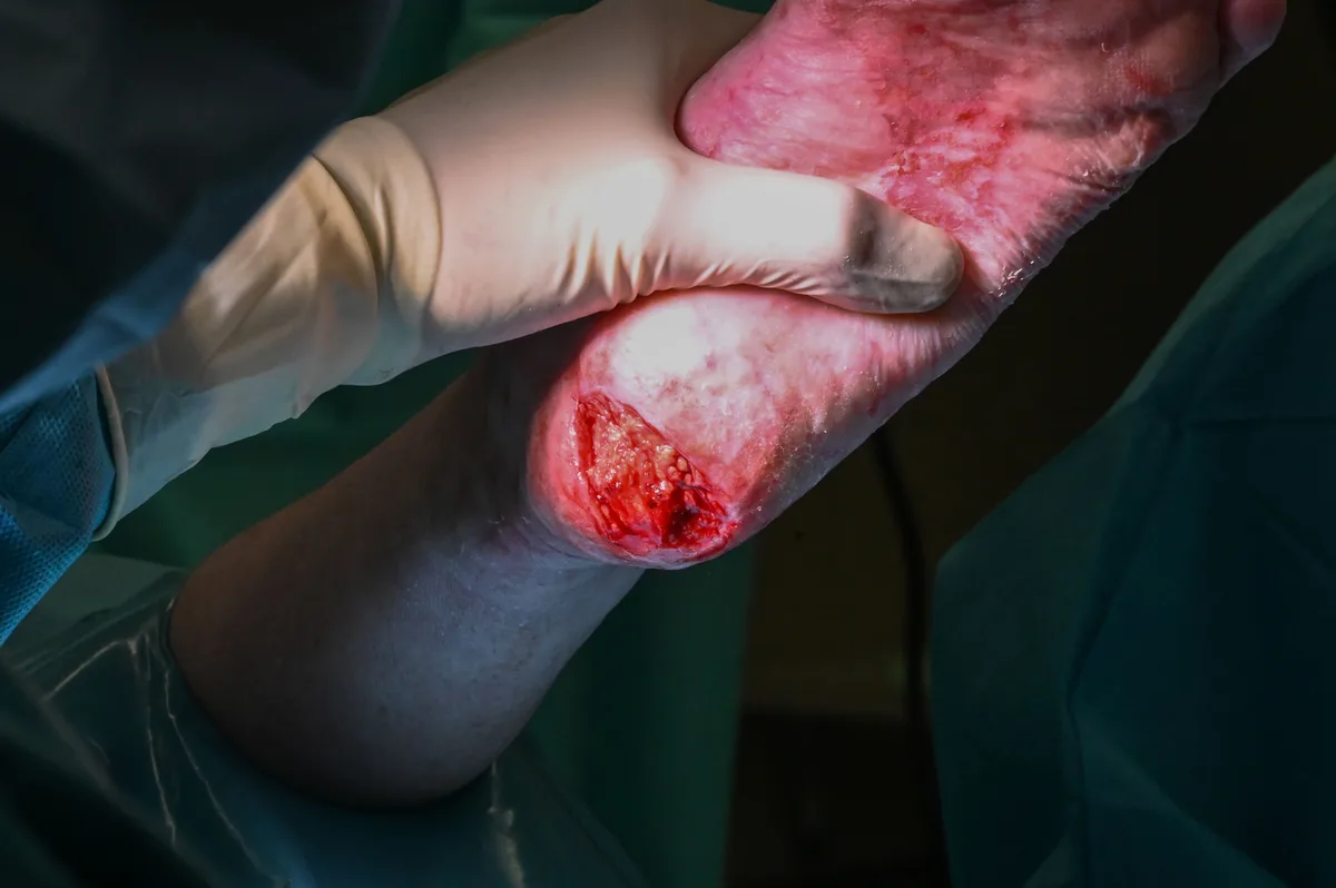 Die offene, gereinigte Wunde an der Ferse ist bereit zur Transplantation der Fischhautstückchen. grosse, offene, blutende Wunde an der Ferse einer Patientin im Operationssaal